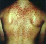 Acne is a common side effect of steroid abuse